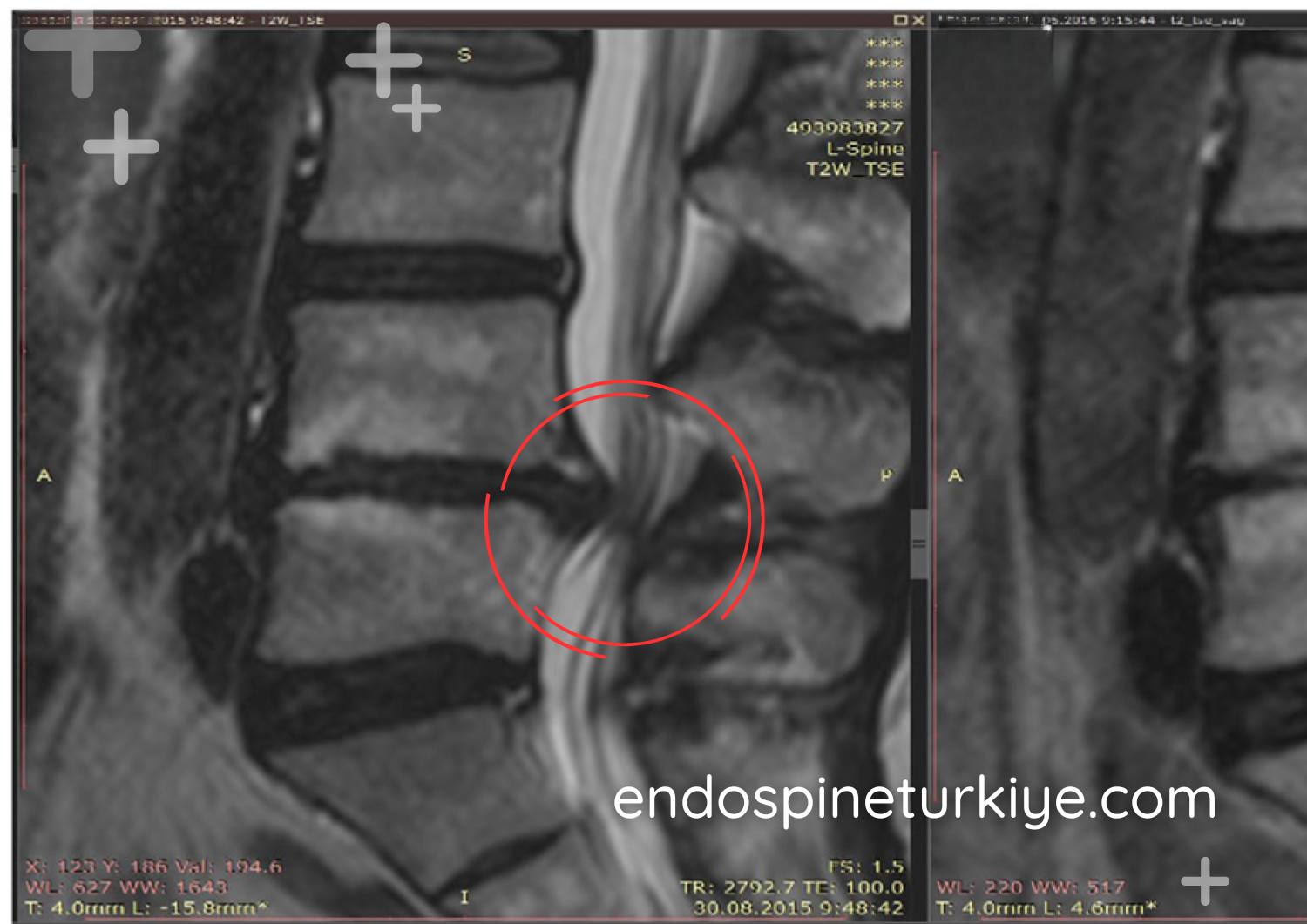 Bel fıtığı tedavi öncesi MR görüntüsü - sinir basısı görülen lomber disk hernisi
