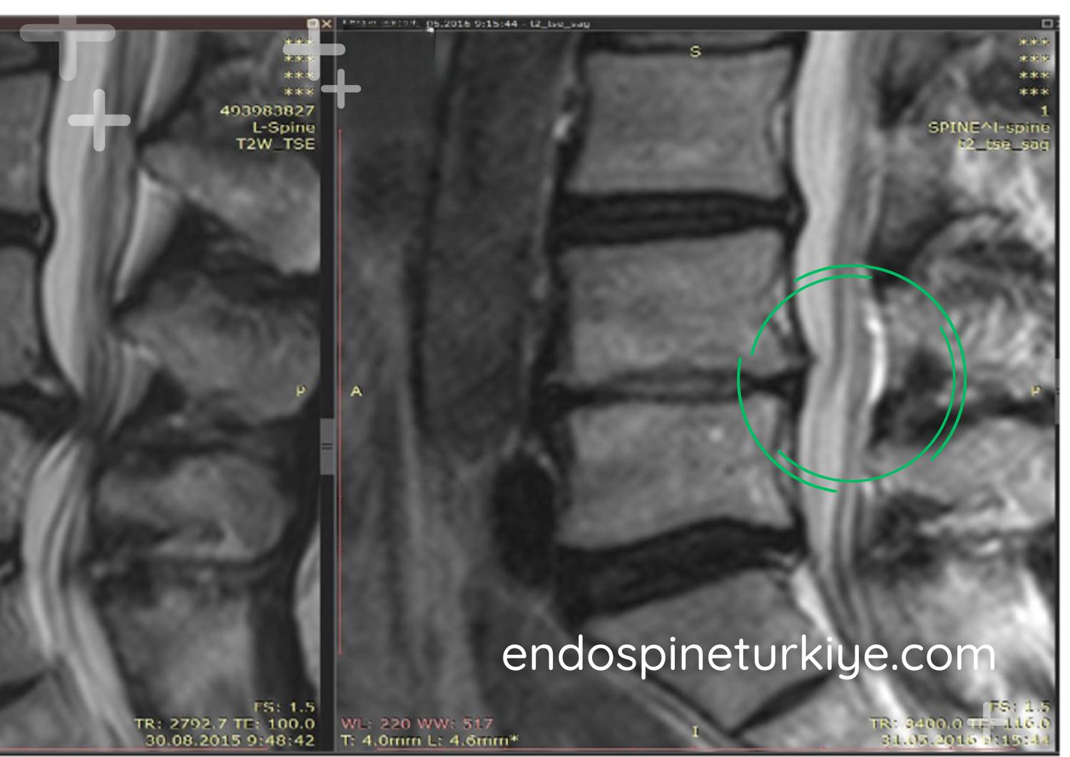 Bel fıtığı tedavi sonrası MR görüntüsü - endoskopik ameliyat ile sinir basısı giderilmiş
