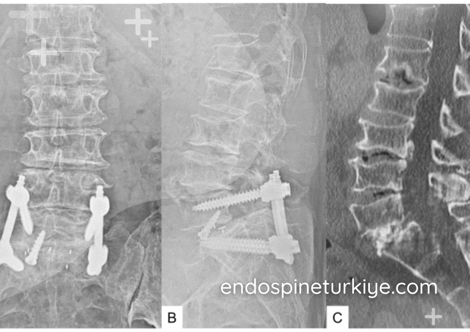 Bel kayması grafi görüntüsü - spondilolistezis derecesi