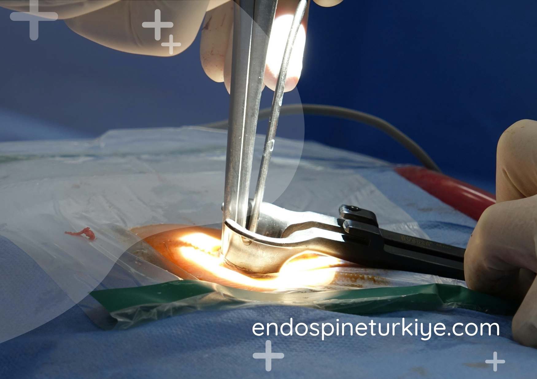 Endoskopik dar kanal ameliyatı - plakasız tam kapalı tedavi