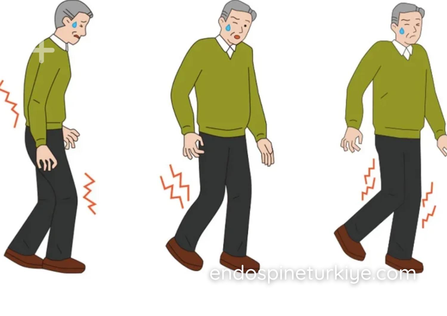 Dar kanal tedavisi sonrası yürüme iyileşmesi