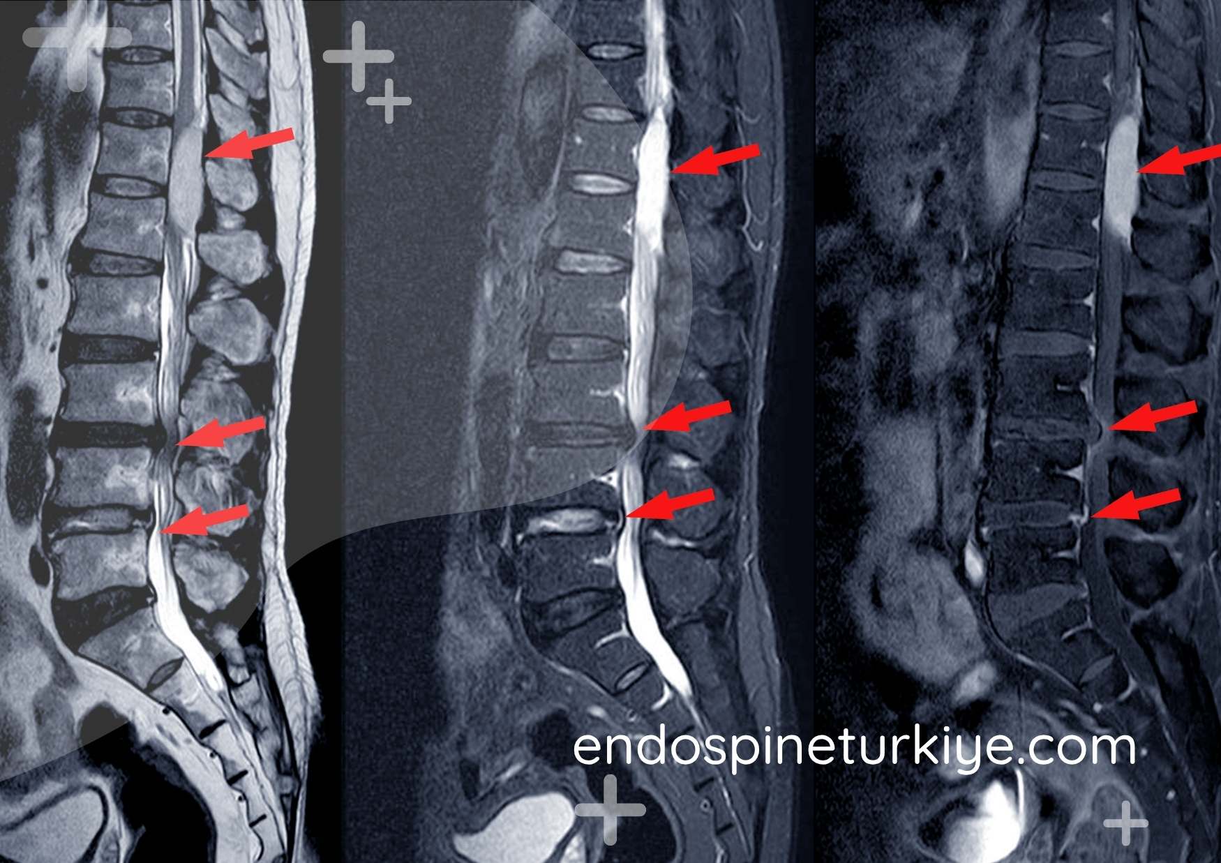 Dar kanal lomber MR görüntüsü - spinal stenoz teşhisi
