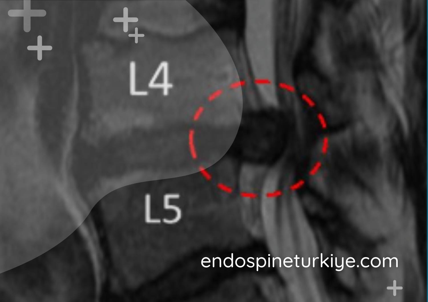 Dar kanal ameliyatı öncesi MR - spinal stenoz görüntüsü
