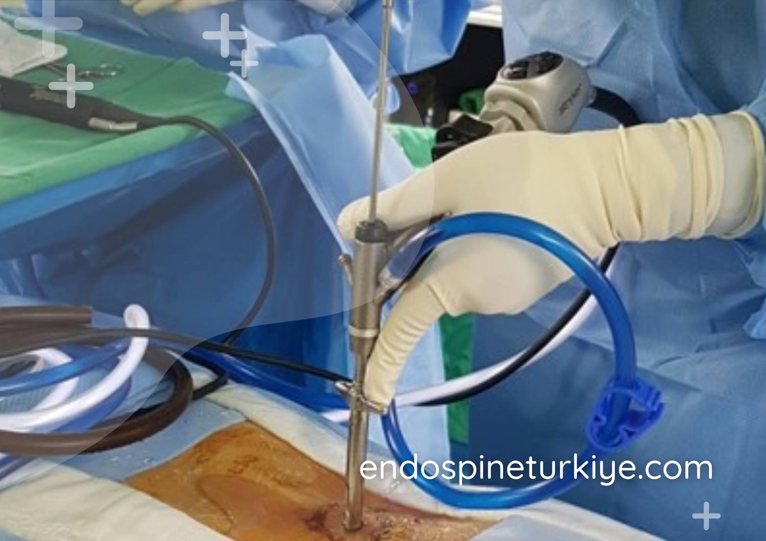 Endoskopik torakal ameliyat - sırt fıtığı cerrahisi prosedürü