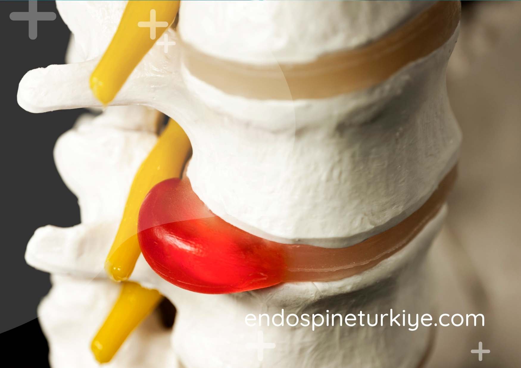 Lazer nükleoplasti PLDD - ameliyatsız bel fıtığı tedavisi